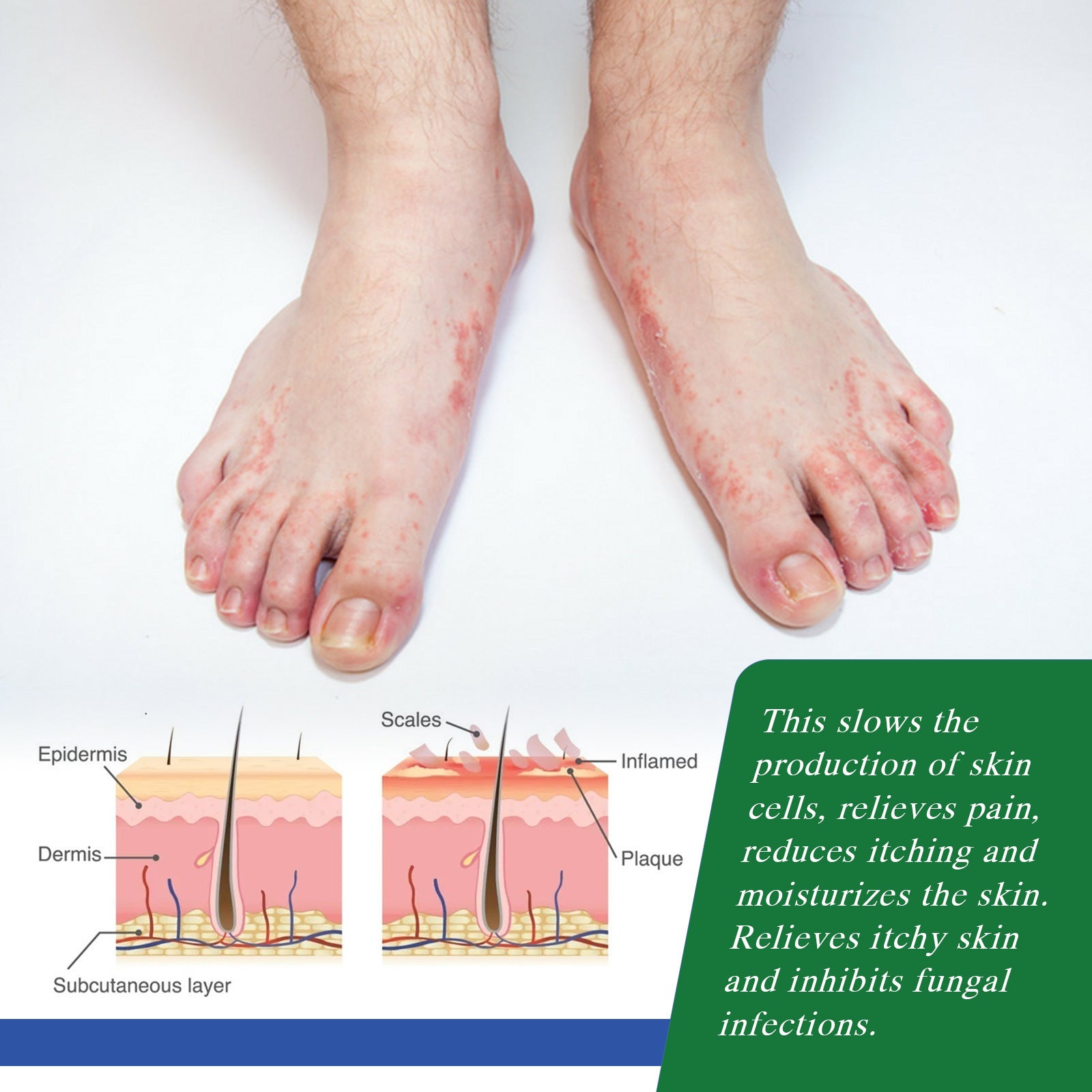 Kraft Moss Cream Relieves Redness And Itching Of Hands And Feet